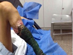 Girls Leg Turned Black and Rot After snakebite